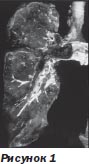 Тромбоемболія легеневої артерії алгоритми діагностики та лікування, інтернет-видання - новини медицини