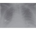 Features of open lung concept in respiratory therapy of severe community-acquired pneumonia