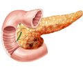 Clinical efficacy of remaxol in the volume infusion therapy of acute pancreatitis