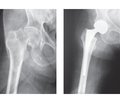Основні критерії прогнозування вивиху головки ендопротеза у хворих із переломами шийки стегнової кістки після однополюсного ендопротезування кульшового суглоба