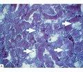 Зміни звивистих канальців нирок при введенні НАДФ на тлі стрептозотоцин-індукованого цукрового діабету в щурів