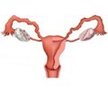 Значення латентної внутрішньоклітинної інфекції у формуванні автоімунного тиреоїдиту в жінок із синдромом полікістозних яєчників