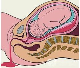 The role and place of exogenous coagulation factors in obstetric hemorrhages