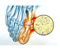 Acute gouty arthritis and rapidly progressive renal failure as manifestation of multiple myeloma:  clinical case description