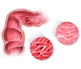 Синдром раздраженного кишечника и кишечный микробиом. От патогенетических механизмов к лечению