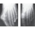 Дифференцированный подход  к выбору вида хирургического пособия  при коррекции вальгусной деформации  первого пальца стопы