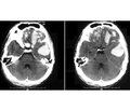 Infection prophylaxis in severe brain injuries: emphasis on ventilator-associated pneumonia and external ventricular drainage