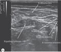 Оцінка аналгетичної ефективності блокади квадратного м’яза поперека (quadratus lumborum block) у дітей після оперативних втручань на органах черевної порожнини