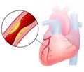 Влияние комбинированной терапии с применением альфа-липоевой кислоты на уровень фракталкина у больных ишемической болезнью сердца и сахарным диабетом 2-го типа