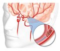Acute stroke in women: features of detection and correction of carbohydrate disorders