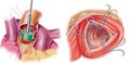 Effect of different surgical approaches to aortic valve replacement on surgical stress degree and systemic inflammatory response