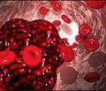 Наружные симптомы у больных   с тромбоэмболией легочной артерии