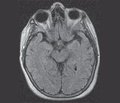 Pituitary Adenoma Stroke-Like Presentation: Clinical Observation