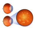 Діабетична ретинопатія: перспективи лікування