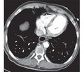 A rare interesting case of fatal air embolism after intravenous contrast during computed tomography