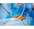 Ризики анестезіологічного забезпечення при лапароскопічних втручаннях на черевній порожнині