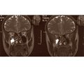 Refractory atypical trigeminal neuralgia associated with reactivated herpesvirus infection: pathogenetic link and efficacy of combination antiviral therapy