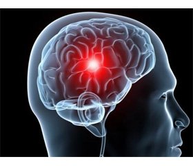 Diagnostics and correction of multiorgan disorders for critical patients with a hemorrhagic stroke