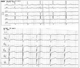 Significance of Osborn Wave in the Choice of Timely Approach to the Treatment of Patients with Hypothermia at an Example of Clinical Case