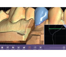 Застосування оптичних скануючих систем та алгоритмів 3D моделювання як спосіб контролю глибини препарування зубів під незнімні ортопедичні конструкції