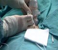 Single-shot femoral nerve block with 0,25% bupivacaine after arthroscopic anterior cruciate ligament reconstruction
