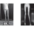 Структурно-функціональний стан кісткової тканини у хворих з артеріовенозними мальформаціями нижніх кінцівок