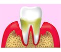 Взаємозв’язок генералізованого пародонтиту та підвищеного рівня продукції паратиреоїдного гормону