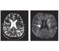 Clinical and neuroimaging analysis of carotid infarction in the acute ischemic stroke