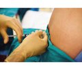Optimization of anesthesic protection for caesarean section