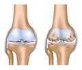 Нетрадиційні методи лікування остеоартрозу колінного суглоба