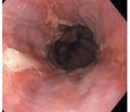 Diagnosis and surgical correction of insufficiency of physiological cardia in hiatal hernia