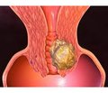 The issue of thrombohemorrhagic complications in patients with endometrial cancer: what is new?