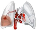 Тромбоемболія легеневої артерії: сучасні погляди на діагностику та лікування