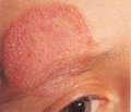 Chronic mucocutaneus candidiasis as a primary immunodeficiency in children